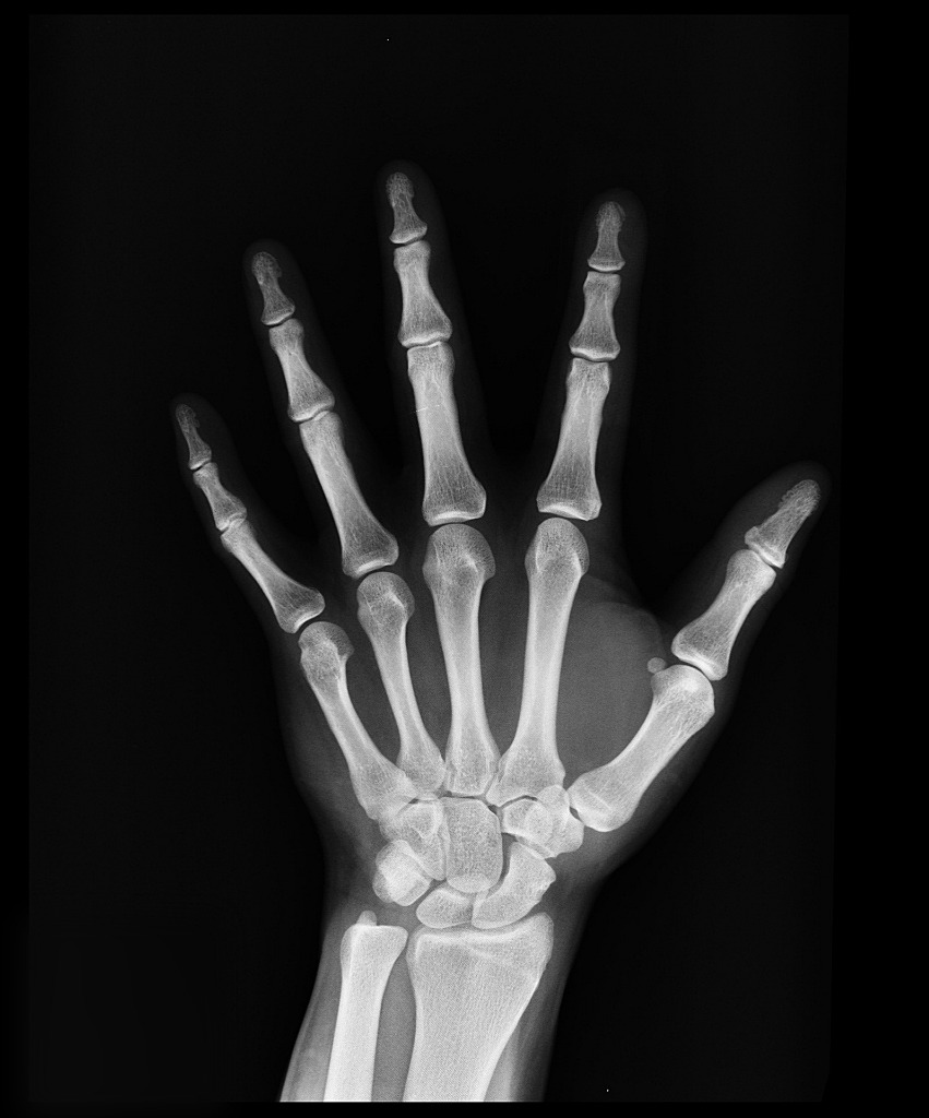 엑스레이 (X-Ray)